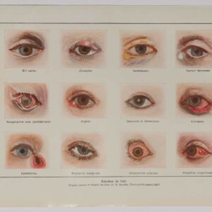 Planche d'anatomie d'époque "Œil maladies" de 1924, décoration scientifique authentique